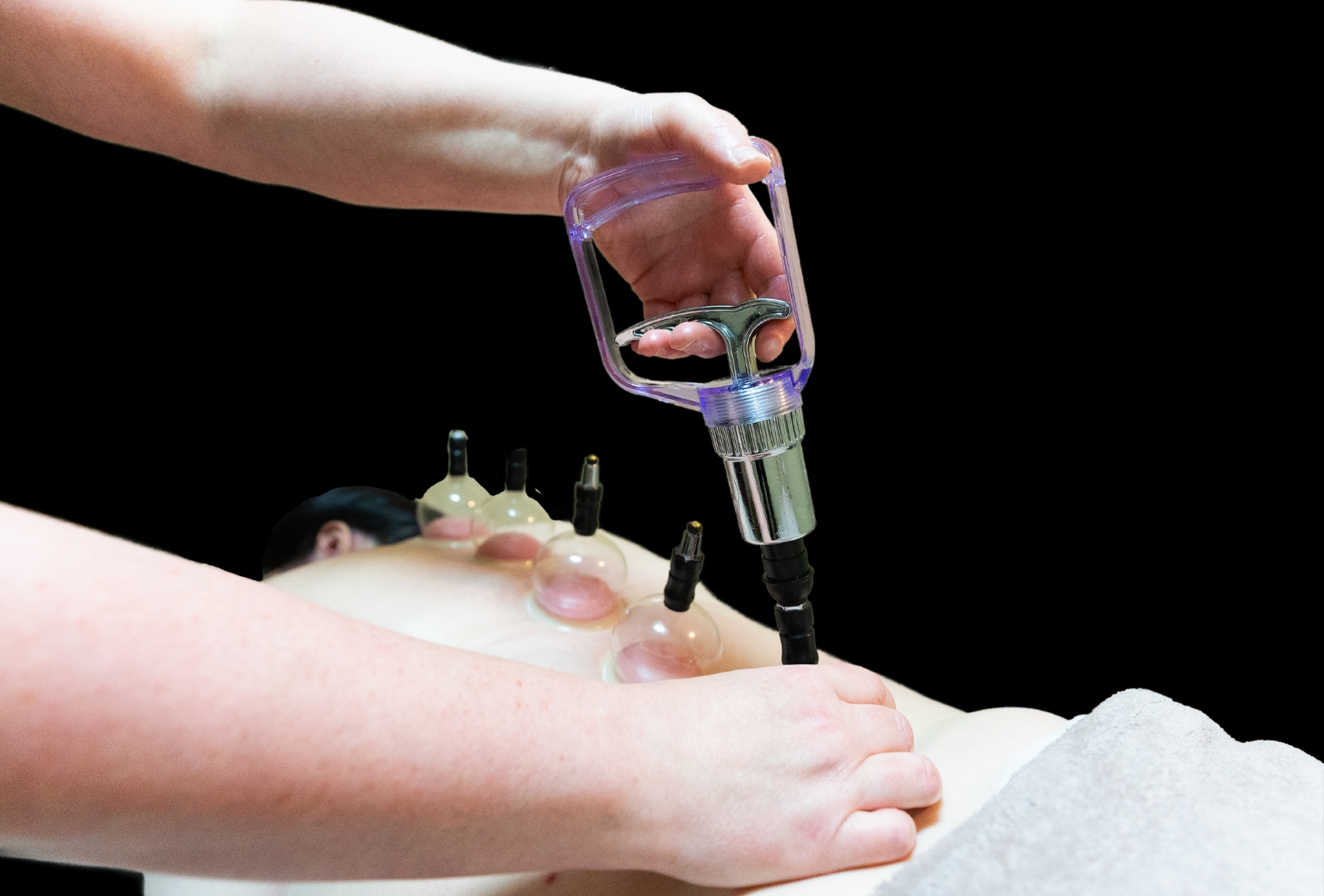 Cedar Meadows Spa & Resort Person receiving a cupping therapy session with multiple cups placed on their back and a hand using a suction device for application. - Timmins, Ontario